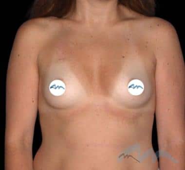 Breast Augmentation Dr Polo 1 b1