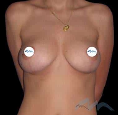 Breast Lift Reduction Dr Polo 1 a1