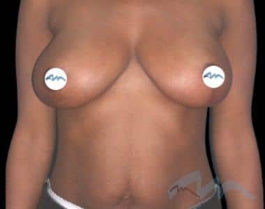 Breast Lift Reduction Dr Polo 2 a1