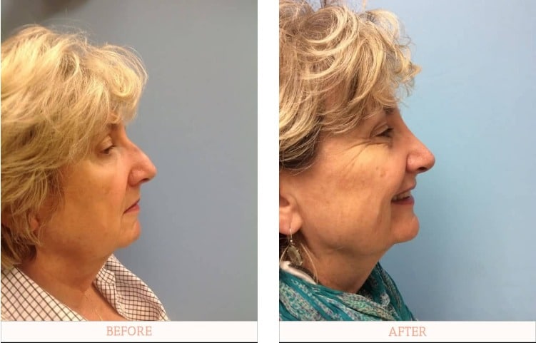 Miami Plastic Surgery before & after image of rhinoplasty