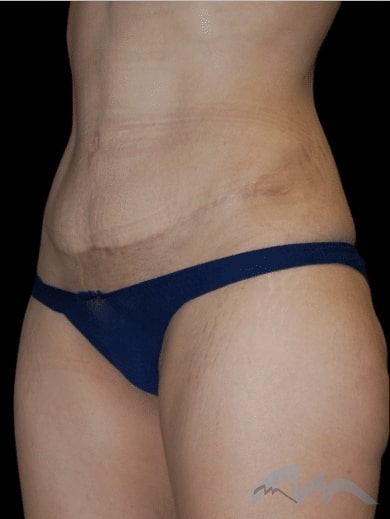 Abdominoplasty Dr Polo 1 A