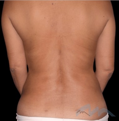 Back Liposuction Dr Polo 1 after edit
