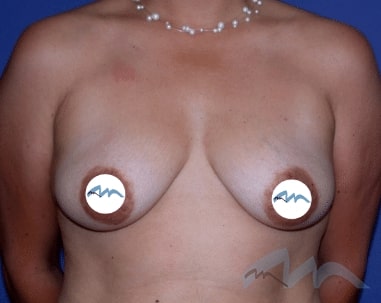 Breast Augmentation Mastopexy Dr Polo b