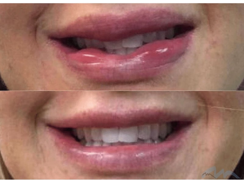 Lip Surgery Biopolymer removal