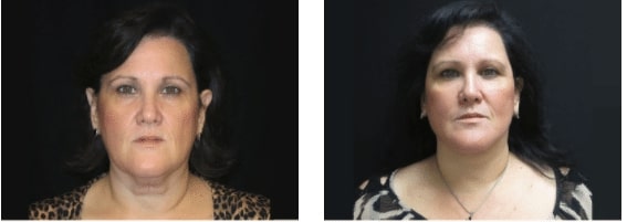 Miami Plastic Surgery's before & after facelift photo