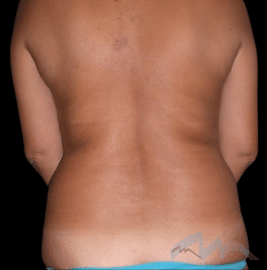 Back Liposuction Dr Polo 1 edit