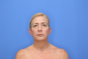Before Image: Blepharoplasty