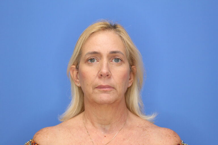 After Image: Blepharoplasty - front