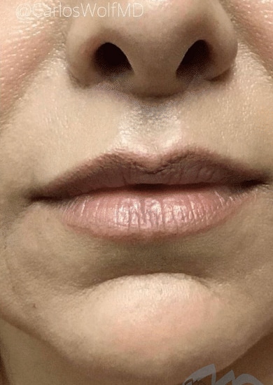 Lip Surgery