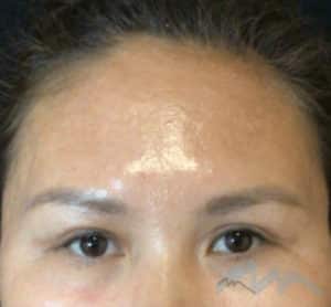 After Image: Blepharoplasty