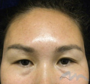 Before Image: Blepharoplasty