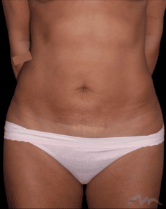 Liposuction