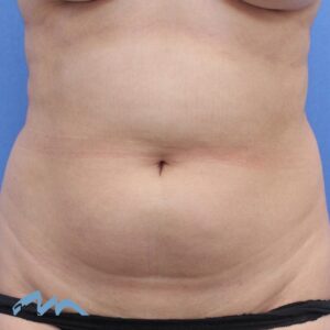 Liposuction