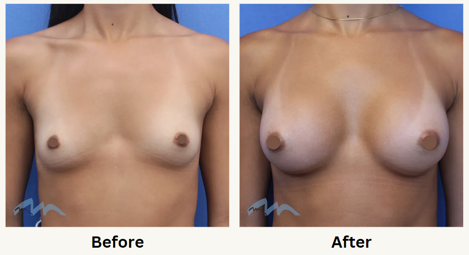 Silicone Breast Implants in Miami
