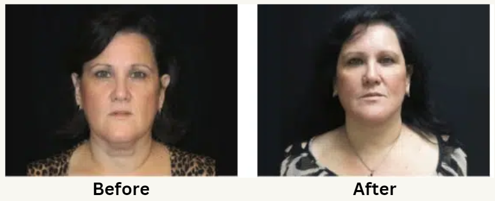 Before and after facelift image