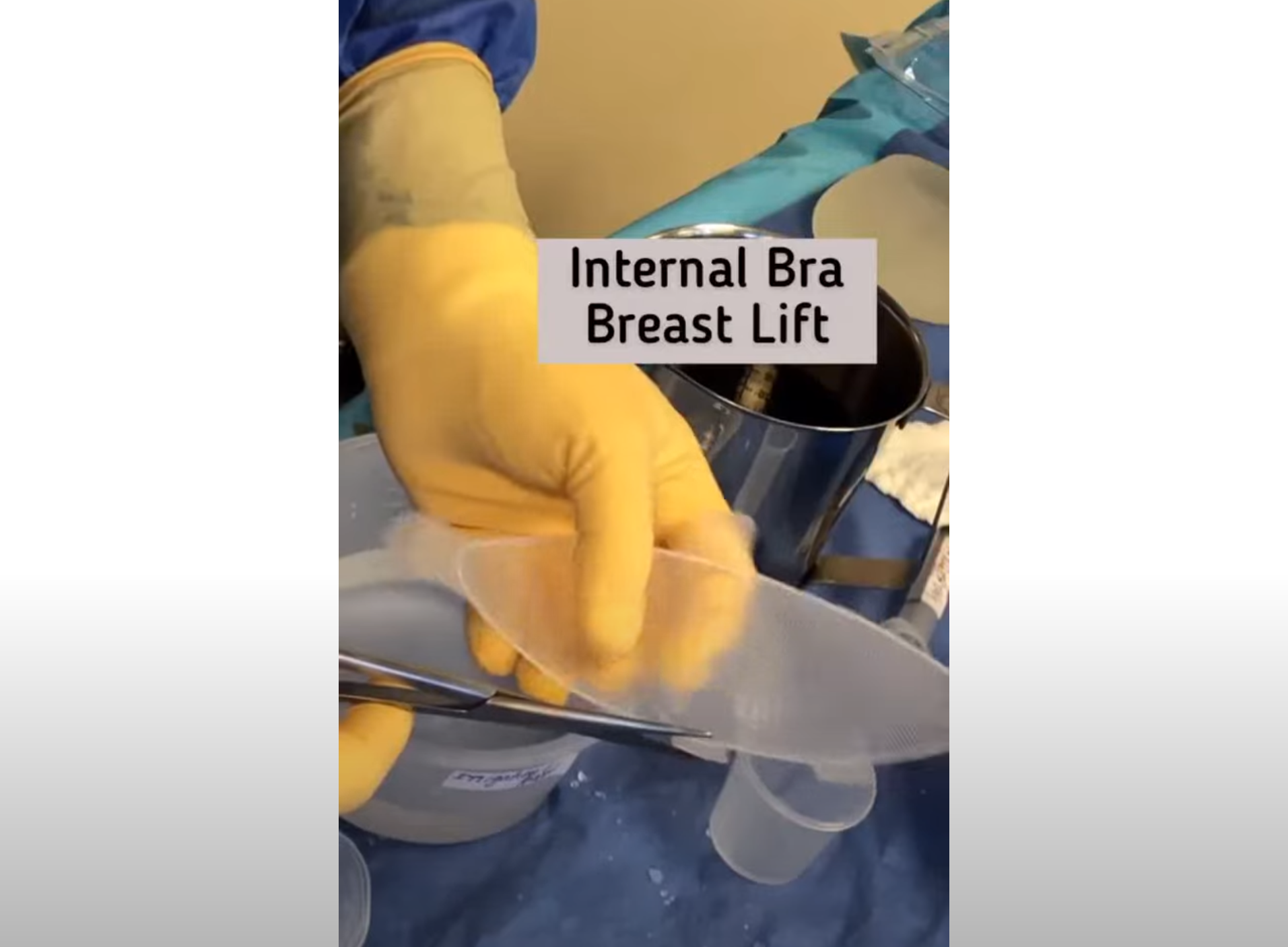 Internal Bra Breast Lift  Silhouette Plastic Surgery Institute