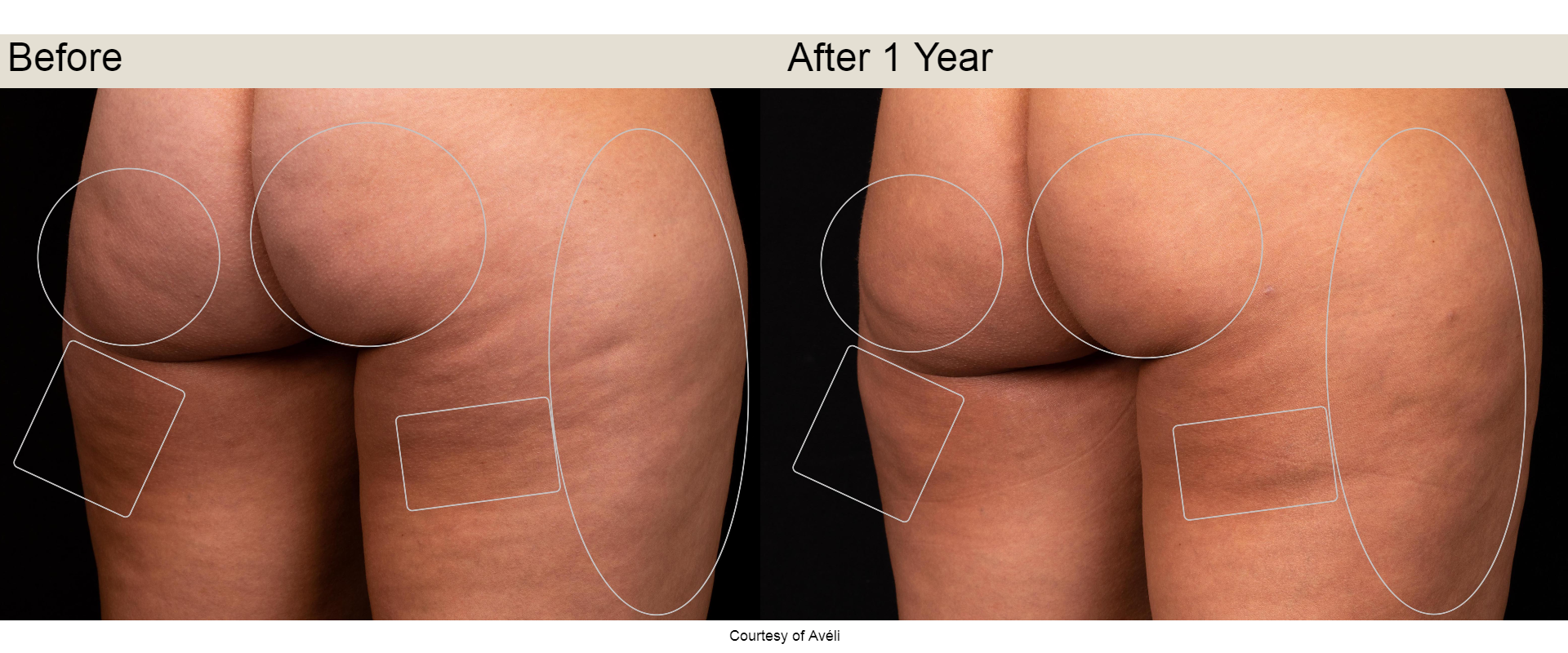 Avéli cellulite procedure before and after