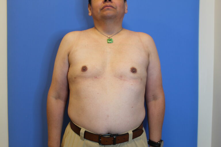 After Image: Gynecomastia - front