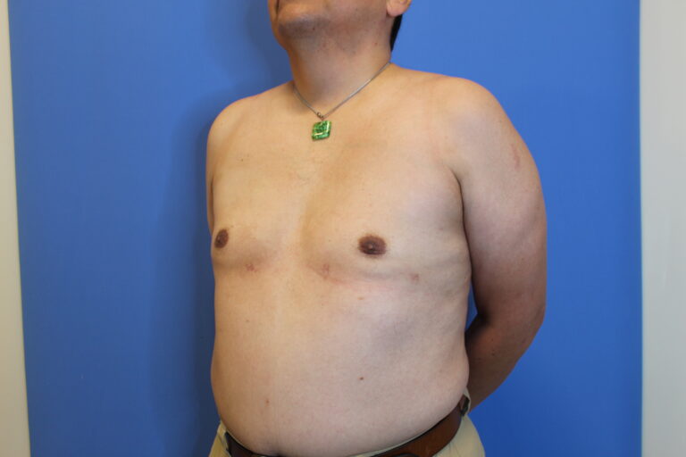 After Image: Gynecomastia - 