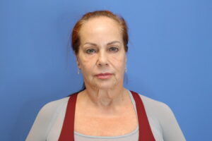 Before Image: Facelift and Necklift