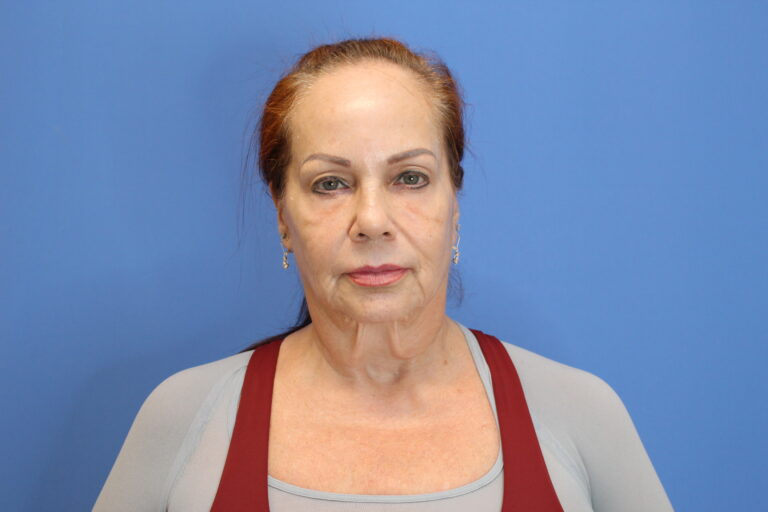 Before Image: Facelift and Necklift - front