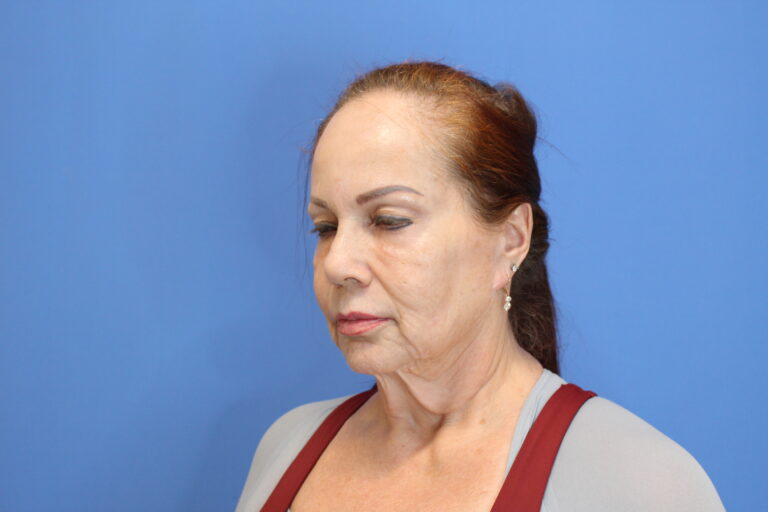 Before Image: Facelift and Necklift - left-front-oblique