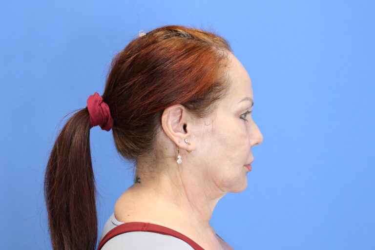 Before Image: Facelift and Necklift - right-side