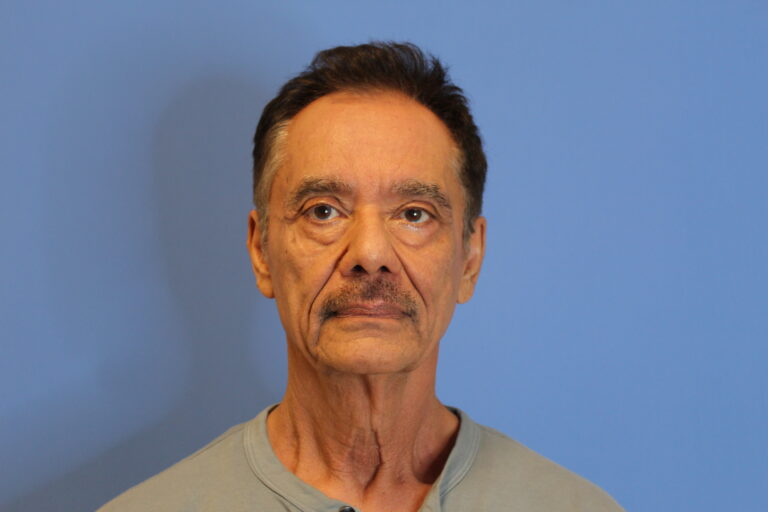 Before Image: Blepharoplasty - front