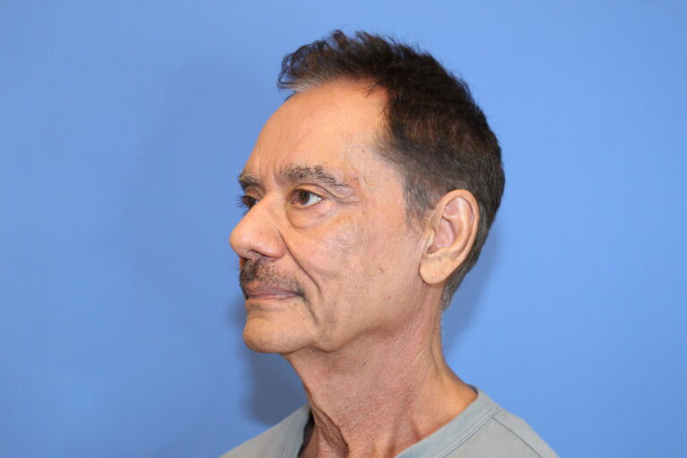 Before Image: Blepharoplasty - left-side