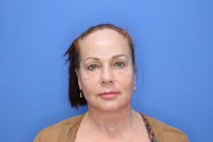 After Image: Facelift and Necklift