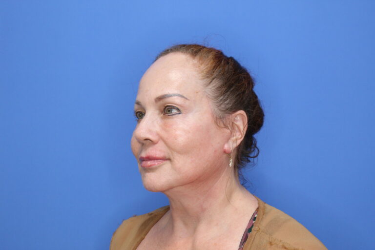 After Image: Facelift and Necklift - left-front-oblique