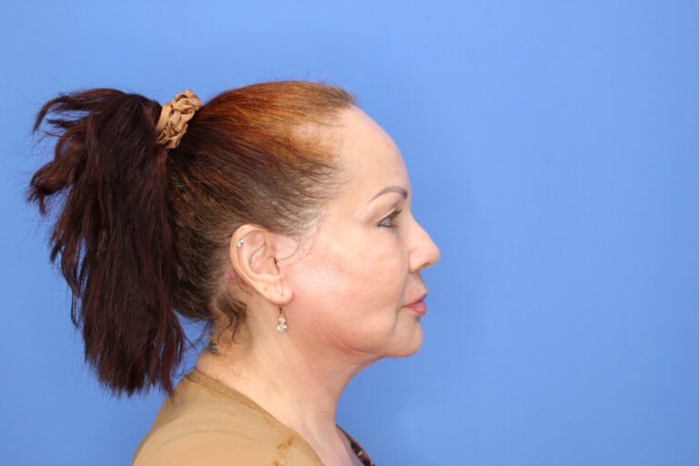 After Image: Facelift and Necklift - right-side