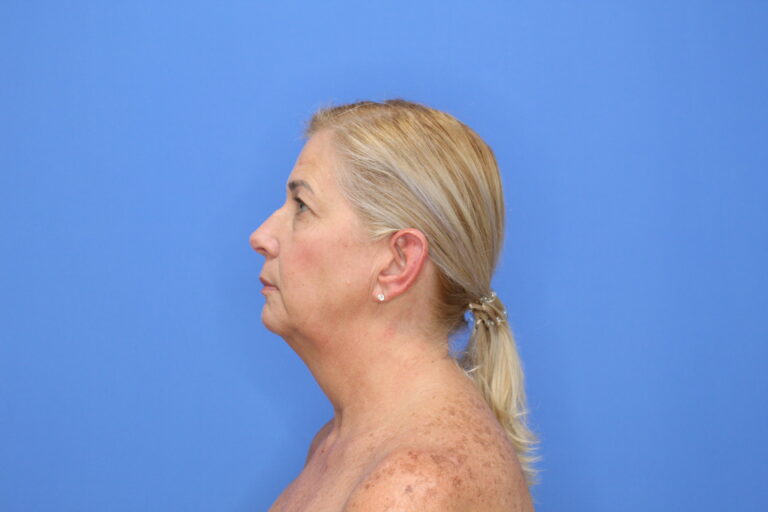 Before Image: Blepharoplasty - front