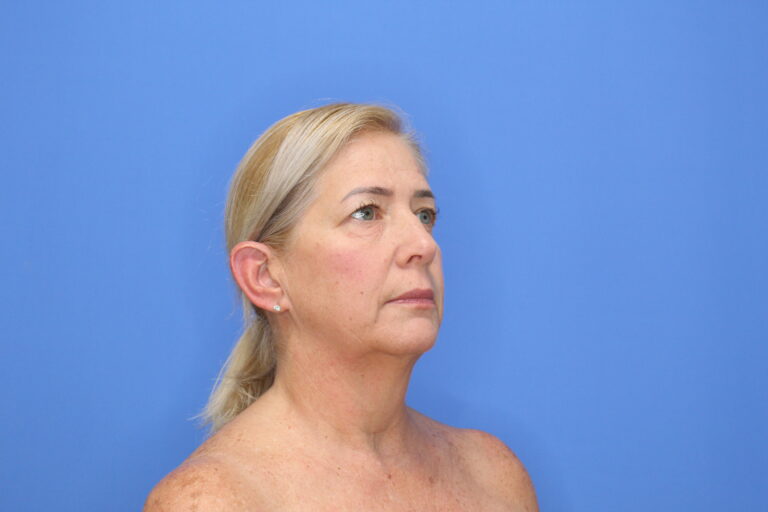 Before Image: Blepharoplasty - right-side