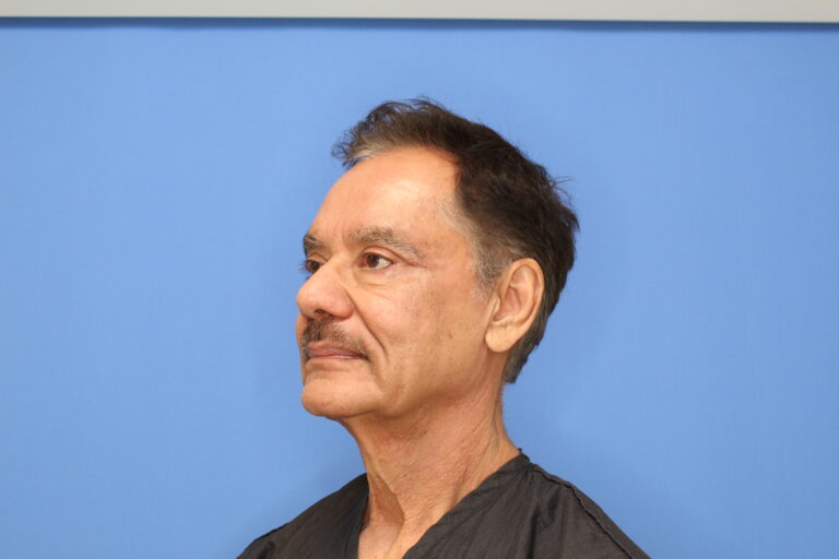 After Image: Blepharoplasty - left-side