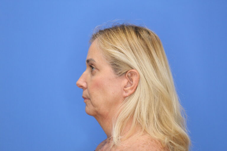 After Image: Blepharoplasty - front