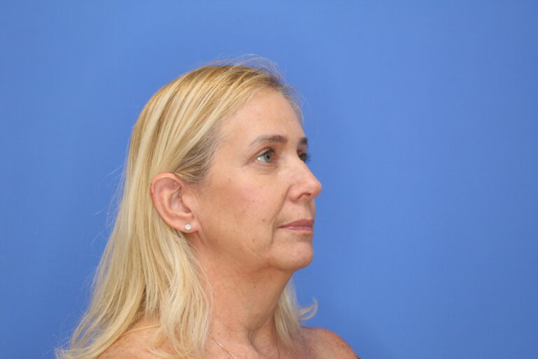 After Image: Blepharoplasty - right-side