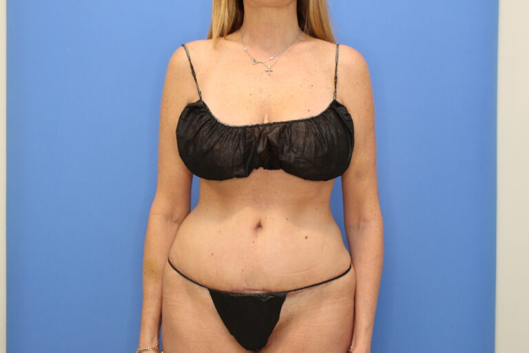 After Image: Abdominoplasty - front