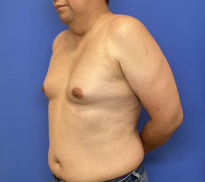 Before Image: Gynecomastia -