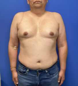 Before Image: Gynecomastia