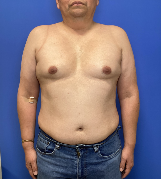 Before Image: Gynecomastia - front