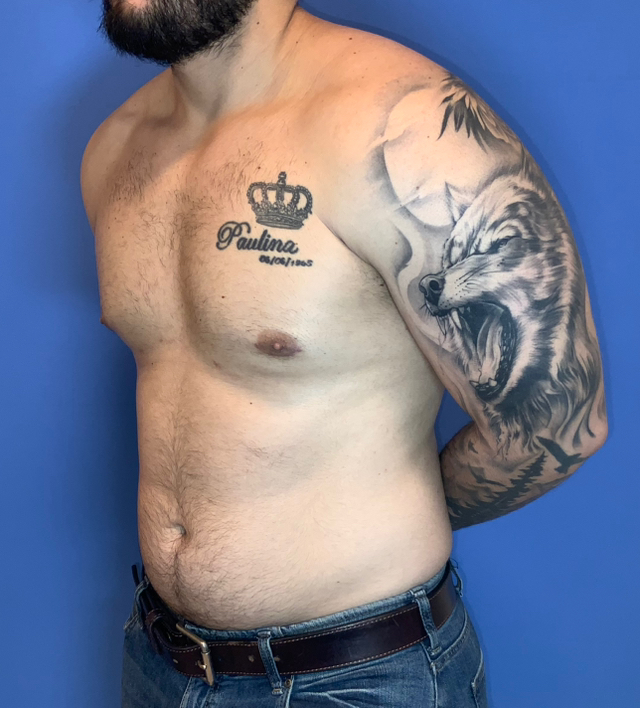 After Image: Gynecomastia - left-side