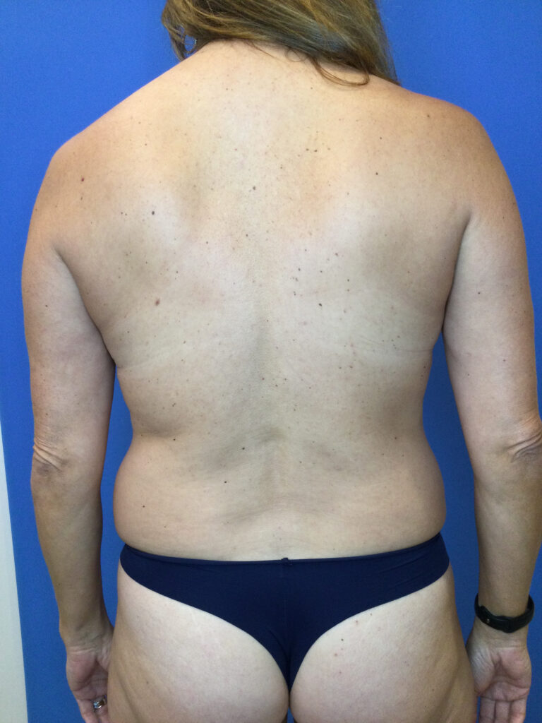 Before Image: Liposuction - front