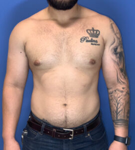 After Image: Gynecomastia