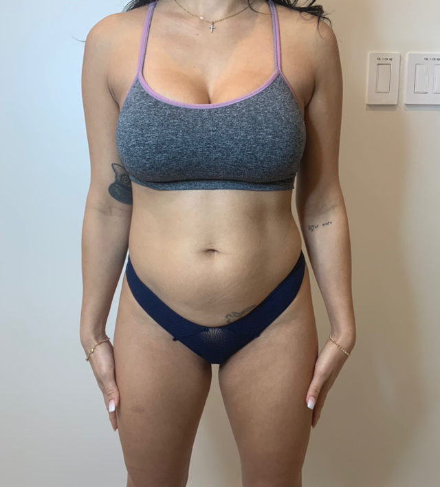 Before Image: Buttock Augmentation - front