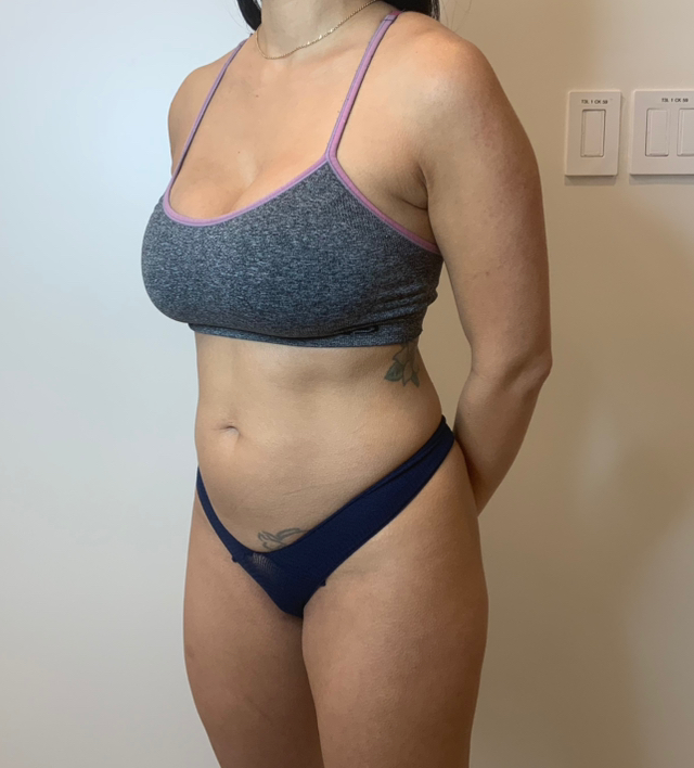 Before Image: Buttock Augmentation - left-front-oblique