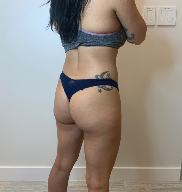 Before Image: Buttock Augmentation - right-back-oblique
