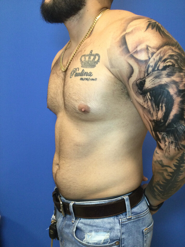 Before Image: Gynecomastia - left-side