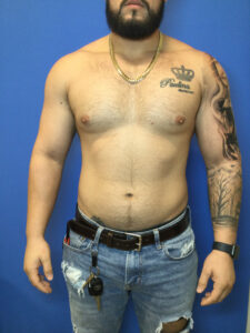 Before Image: Gynecomastia