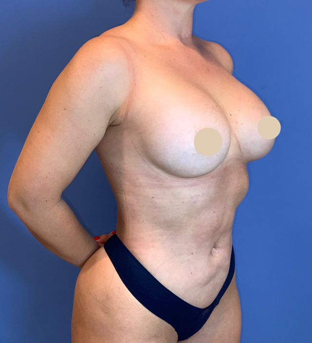 After Image: Liposuction - right-front-oblique